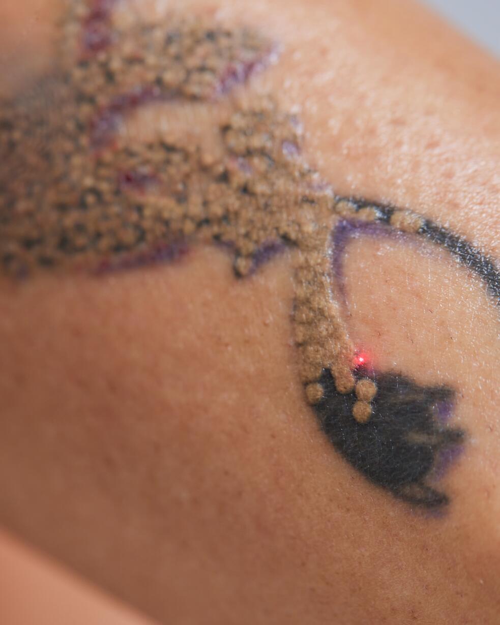 tatuoinnin poistosta jäänyt arpi